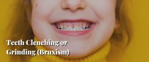 Teeth Clenching or Grinding (Bruxism)